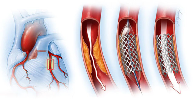 Процесс восстановления после стентирования сосудов сердца: диета, ЛФК и психологические аспекты