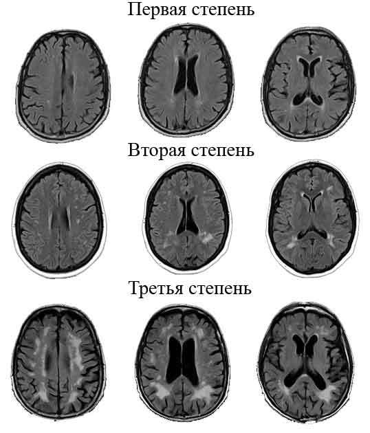 Признаки перивентрикулярного лейкоареоза головного мозга: снижение памяти и резка смена настроения