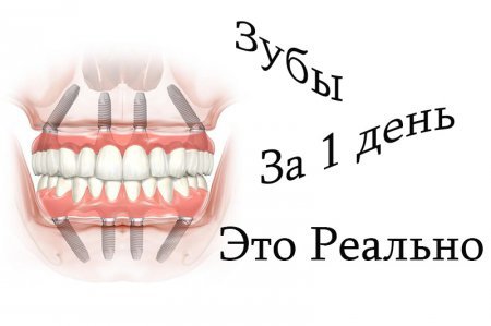 Правда или вымысел – все зубы за 1 день? Технология протезирования all-on-4