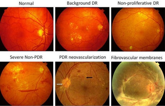 Диабетическая ретинопатия: симптомы и лечение