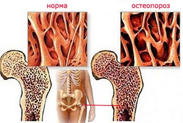 Перелом в пожилом возрасте - что такое остеопороз (симптомы)