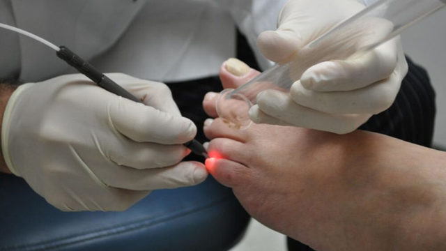 Как лечить онихокриптоз ногтей: медикаменты, ванночки, хирургическое вмешательство и народная медицина