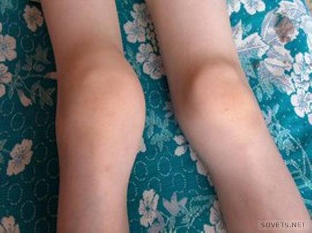 Лечение артроза коленного сустава в домашних условиях: гимнастика и народные методы