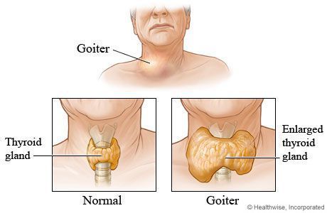 Узловой зоб щитовидной железы: симптомы и лечение