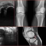 Синовиальная киста коленного сустава: причины развития и диагностика заболевания